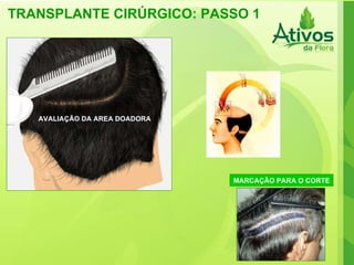 TRANSPLANTE CIRÚRGICO: PASSO 1 AVALIAÇÃO DA AREA DOADORA MARCAÇÃO PARA O CORTE 