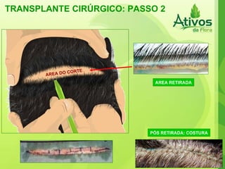 TRANSPLANTE CIRÚRGICO: PASSO 2 AREA DO CORTE AREA RETIRADA PÓS RETIRADA: COSTURA 