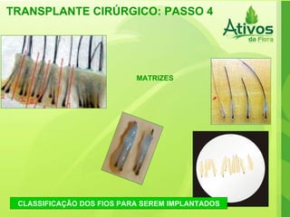 TRANSPLANTE CIRÚRGICO: PASSO 4 CLASSIFICAÇÃO DOS FIOS PARA SEREM IMPLANTADOS 1 MATRIZES 