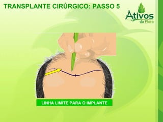 TRANSPLANTE CIRÚRGICO: PASSO 5 LINHA LIMITE PARA O IMPLANTE 