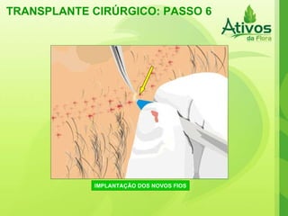 TRANSPLANTE CIRÚRGICO: PASSO 6 IMPLANTAÇÃO DOS NOVOS FIOS 