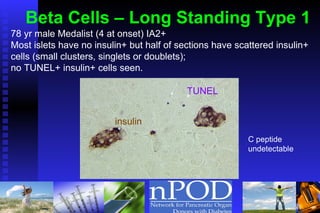 78 yr male Medalist (4 at onset) IA2+ Most islets have no insulin+ but half of sections have scattered insulin+ cells (small clusters, singlets or doublets);  no TUNEL+ insulin+ cells seen. insulin TUNEL C peptide undetectable Beta Cells – Long Standing Type 1 