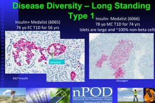 Disease Diversity – Long Standing Type 1 Ki67+Insulin Amyloid Insulin+ Medalist (6065) 76 yo FC T1D for 56 yrs Insulin- Medalist (6066) 78 yo MC T1D for 74 yrs Islets are large and ~100% non-beta cells Glucagon  