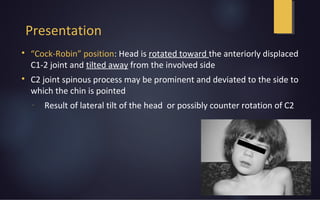 Presentation

“Cock-Robin” position: Head is rotated toward the anteriorly displaced
C1-2 joint and tilted away from the involved side

C2 joint spinous process may be prominent and deviated to the side to
which the chin is pointed
- Result of lateral tilt of the head or possibly counter rotation of C2
 
