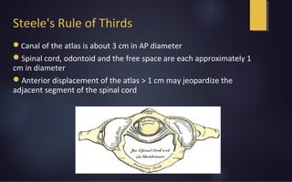 Steele's Rule of Thirds
Canal of the atlas is about 3 cm in AP diameter
Spinal cord, odontoid and the free space are each approximately 1
cm in diameter
Anterior displacement of the atlas > 1 cm may jeopardize the
adjacent segment of the spinal cord
 