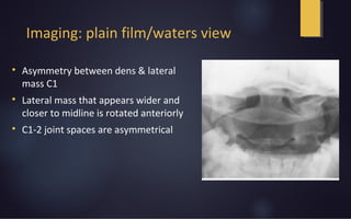 Imaging: plain film/waters view

Asymmetry between dens & lateral
mass C1

Lateral mass that appears wider and
closer to midline is rotated anteriorly

C1-2 joint spaces are asymmetrical
 