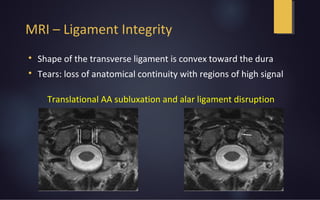 MRI – Ligament Integrity

Shape of the transverse ligament is convex toward the dura

Tears: loss of anatomical continuity with regions of high signal
Translational AA subluxation and alar ligament disruption
 