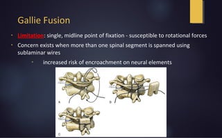 Gallie Fusion
•
Limitation: single, midline point of fixation - susceptible to rotational forces
•
Concern exists when more than one spinal segment is spanned using
sublaminar wires
•
increased risk of encroachment on neural elements
 