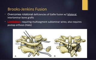 Brooks-Jenkins Fusion
• Overcomes rotational deficiencies of Gallie fusion w/ bilateral,
interlaminar bone grafts
• Limitation: requiring multisegment sublaminar wires; also requires
postop orthosis (Halo)
 