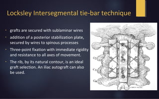 Locksley Intersegmental tie-bar technique
•
grafts are secured with sublaminar wires
•
addition of a posterior stabilization plate,
secured by wires to spinous processes
•
Three-point fixation with immediate rigidity
and resistance to all axes of movement.
•
The rib, by its natural contour, is an ideal
graft selection. An iliac autograft can also
be used.
 