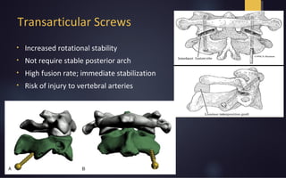 Transarticular Screws
• Increased rotational stability
• Not require stable posterior arch
• High fusion rate; immediate stabilization
• Risk of injury to vertebral arteries
 