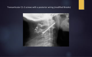 Transarticular C1-2 screws with a posterior wiring (modified Brooks)
 