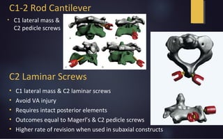 C1-2 Rod Cantilever
• C1 lateral mass &
C2 pedicle screws
C2 Laminar Screws
• C1 lateral mass & C2 laminar screws
• Avoid VA injury
• Requires intact posterior elements
• Outcomes equal to Magerl’s & C2 pedicle screws
• Higher rate of revision when used in subaxial constructs
 