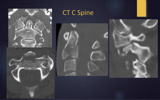 CT C Spine
 