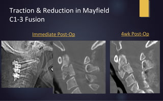 Traction & Reduction in Mayfield
C1-3 Fusion
Immediate Post-Op 4wk Post-Op
 