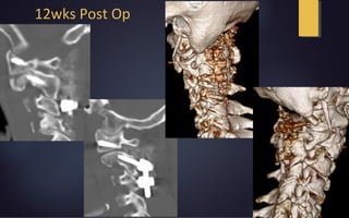 12wks Post Op
 