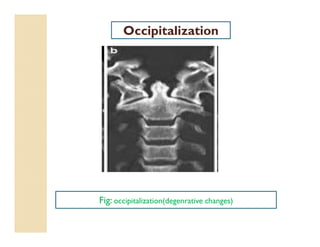 Fig: occipitalization(degenrative changes)
Occipitalization
 