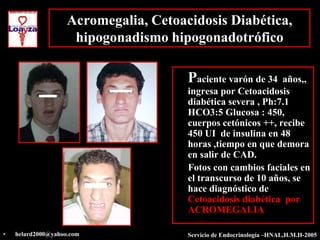 Acromegalia, Cetoacidosis Diabética,
                     hipogonadismo hipogonadotrófico

                                       Paciente varón de 34   años,,
                                       ingresa por Cetoacidosis
                                       diabética severa , Ph:7.1
                                       HCO3:5 Glucosa : 450,
                                       cuerpos cetónicos ++, recibe
                                       450 UI de insulina en 48
                                       horas ,tiempo en que demora
                                       en salir de CAD.
                                       Fotos con cambios faciales en
                                       el transcurso de 10 años, se
                                       hace diagnóstico de
                                       Cetoacidosis diabética por
                                       ACROMEGALIA

•   helard2000@yahoo.com               Servicio de Endocrinología –HNAL,H.M.H-2005
 