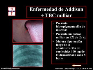 Enfermedad de Addison
                           + TBC milliar
                                • Presenta
                                  hiperpigmentación de
                                  mucosas
                                • Presenta un patrón
                                  milliar en RX de tórax
                                • Mejora hipotensión
                                  luego de la
                                  administración de
                                  corticoides 100 mg de
                                  Hidrocortisona cada 8
                                  horas


helard2000@yahoo.com             Servicio de Endocrinología –HNAL,H.M.H-2005
 