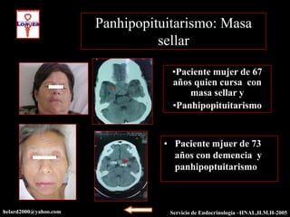 Panhipopituitarismo: Masa
                                 sellar

                                   •Paciente mujer de 67
                                   años quien cursa con
                                       masa sellar y
                                   •Panhipopituitarismo


                                 • Paciente mjuer de 73
                                   años con demencia y
                                   panhipoptuitarismo



helard2000@yahoo.com              Servicio de Endocrinología –HNAL,H.M.H-2003
                                                             –HNAL,H.M.H-2005
 