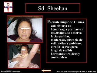Sd. Sheehan

                          Paciente mujer de 41 años
                            con historia de
                            hemorragia postparto a
                            los 30 años, se observa
                            facies pálidas,
                            madarosis, ausencia de
                            vello axilar y pubiano,
                            atrofia se recupera
                            luego de recibir
                            hormonas tiroideas y
                            corticoideas.



helard2000@yahoo.com            Servicio de Endocrinología –HNAL,H.M.H-2003
                                                           –HNAL,H.M.H-2005
 