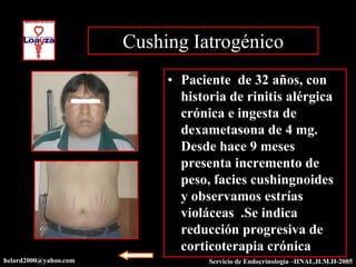 Cushing Iatrogénico
                            • Paciente de 32 años, con
                              historia de rinitis alérgica
                              crónica e ingesta de
                              dexametasona de 4 mg.
                              Desde hace 9 meses
                              presenta incremento de
                              peso, facies cushingnoides
                              y observamos estrías
                              violáceas .Se indica
                              reducción progresiva de
                              corticoterapia crónica
helard2000@yahoo.com               Servicio de Endocrinología –HNAL,H.M.H-2005
 