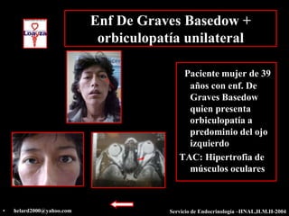 Enf De Graves Basedow +
                            orbiculopatía unilateral

                                           Paciente mujer de 39
                                            años con enf. De
                                            Graves Basedow
                                            quien presenta
                                            orbiculopatía a
                                            predominio del ojo
                                            izquierdo
                                          TAC: Hipertrofia de
                                            músculos oculares



•   helard2000@yahoo.com               Servicio de Endocrinología –HNAL,H.M.H-2004
 