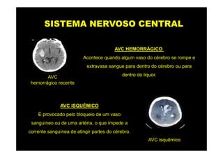SISTEMA NERVOSO CENTRAL

                                        AVC HEMORRÁGICO
                         Acontece quando algum vaso do cérebro se rompe e
                           extravasa sangue para dentro do cérebro ou para

        AVC                                 dentro do liquor.
 hemorrágico recente



              AVC ISQUÉMICO
    É provocado pelo bloqueio de um vaso
 sanguíneo ou de uma artéria, o que impede a
corrente sanguínea de atingir partes do cérebro.
                                                         AVC isquêmico
 