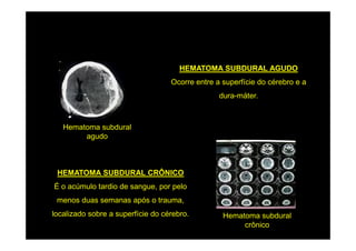 HEMATOMA SUBDURAL AGUDO
                                   Ocorre entre a superfície do cérebro e a
                                                 dura-máter.



   Hematoma subdural
        agudo



 HEMATOMA SUBDURAL CRÔNICO
É o acúmulo tardio de sangue, por pelo
 menos duas semanas após o trauma,
localizado sobre a superfície do cérebro.         Hematoma subdural
                                                       crônico
 