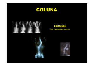 COLUNA


       ESCOLIOSE
   São desvios da coluna
 