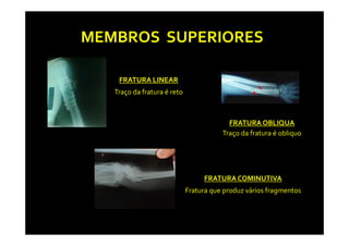 MEMBROS SUPERIORES

    FRATURA LINEAR
   Traço da fratura é reto



                                          FRATURA OBLIQUA
                                        Traço da fratura é obliquo




                                  FRATURA COMINUTIVA
                             Fratura que produz vários fragmentos
 