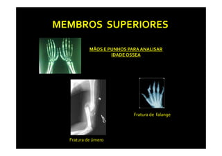 MEMBROS SUPERIORES

           MÃOS E PUNHOS PARA ANALISAR
                   IDADE OSSEA




                           Fratura de falange




  Fratura de úmero
 
