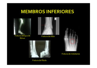 MEMBROS INFERIORES



Fratura obliqua de              Fratura de tíbia
      fêmur




                                                   Fratura de metatarso


                     Fratura de fíbula
 