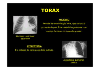 TORAX
                                            ABCESSO
                            Resulta de uma infecção local, que conduz à
                          produção de pus. Este material organiza-se num
                               espaço fechado, com parede grossa.

 Abcesso pulmonar
     esquerdo


            ATELECTASIA
É o colapso de parte ou de todo pulmão.



                                                Atelectasia pulmonar
                                                        direita
 