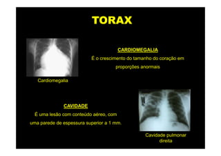 TORAX

                                        CARDIOMEGALIA
                          É o crescimento do tamanho do coração em
                                     proporções anormais

   Cardiomegalia




              CAVIDADE
  É uma lesão com conteúdo aéreo, com
uma parede de espessura superior a 1 mm.

                                                 Cavidade pulmonar
                                                       direita
 
