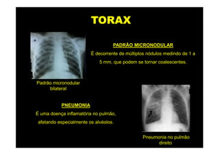 TORAX

                                  PADRÃO MICRONODULAR
                        É decorrente de múltiplos nódulos medindo de 1 a
                            5 mm, que podem se tornar coalescentes.



Padrão micronodular
     bilateral


           PNEUMONIA
É uma doença inflamatória no pulmão,
afetando especialmente os alvéolos.


                                               Pneumonia no pulmão
                                                     direito
 