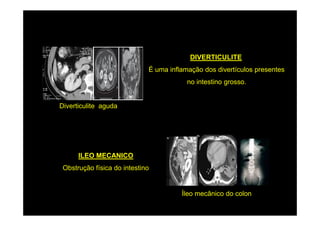 DIVERTICULITE
                             É uma inflamação dos divertículos presentes
                                         no intestino grosso.


Diverticulite aguda




      ILEO MECANICO
 Obstrução física do intestino


                                       Íleo mecânico do colon
 