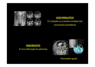 ILEO PARALITICO
                            É a redução ou a parada completa dos
                                  movimentos peristalticos




       PANCREATITE
É uma inflamação do pâncreas.



                                         Pancreatite aguda
 