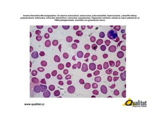 Anemia Hemolítica Microangiopática: Se observa anisocitosis, anisocromia, policromatofilia, hipercromasia y basofilia difusa,
poiquilocitosis, esferocitos, eritrocitos dismórficos, crenocitos, esquistocitos, fragmentos celulares, células en casco además de un
PMN polisegmentado, neutrófilo con granulación tóxica.

www.qualitat.cc

 