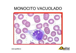 MONOCITO VACUOLADO

www.qualitat.cc

 