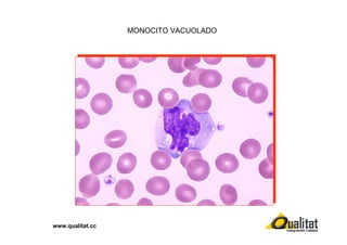 MONOCITO VACUOLADO

www.qualitat.cc

 