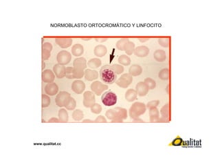 NORMOBLASTO ORTOCROMÁTICO Y LINFOCITO

www.qualitat.cc

 