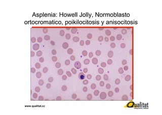 Asplenia: Howell Jolly, Normoblasto
ortocromatico, poikilocitosis y anisocitosis

www.qualitat.cc

 