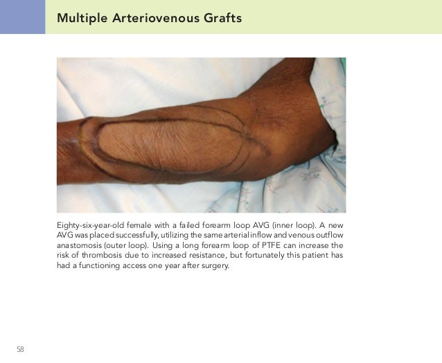 Skin Grafting - procedure, recovery, blood, pain ...