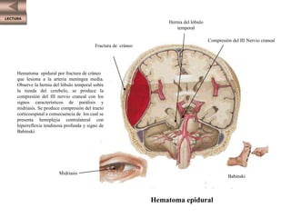 LECTURA
Hematoma epidural por fractura de cráneo
que lesiona a la arteria meníngea media.
Observe la hernia del lóbulo temporal sobre
la tienda del cerebelo, se produce la
compresión del III nervio craneal con los
signos característicos de parálisis y
midriasis. Se produce compresión del tracto
corticoespinal a consecuencia de los cual se
presenta hemiplejia contralateral con
hiperreflexia tendinosa profunda y signo de
Babinski.
Fractura de cráneo
Midriasis
Hernia del lóbulo
temporal
Compresión del III Nervio craneal
Babinski
Hematoma epidural
 