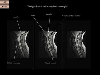 LECTURA
cerebelo
Puente
cerebelo
Cisterna cerebelo-medular
Médula espinal
Médula oblongada
Tomografía de la médula espinal, vista sagital
 