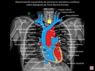 Representación esquemática de estructuras vasculares y cardíacas
sobre Radiografía de Tórax Normal (Frente)
 