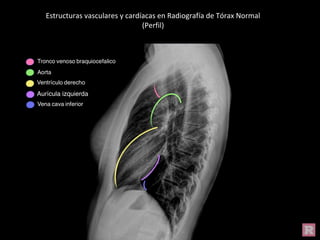 Estructuras vasculares y cardíacas en Radiografía de Tórax Normal
(Perfil)
 