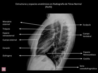 Estructuras y espacios anatómicos en Radiografía de Tórax Normal
(Perfil)
Manubrio
esternal
Tráquea
Espacio
retroesternal
Cuerpo esternal
Corazón
Diafragma
Escápula
Cuerpo
Vertebral
Espacio
Retrocardiaco
Costilla
Seno
costodiafragmático
 