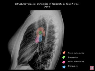 Estructuras y espacios anatómicos en Radiografía de Tórax Normal
(Perfil)
Arteria pulmonar izq
Bronquio izq
Arteria pulmonar der
Bronquio der
 